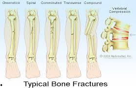 破裂 LaFracture,揭秘破裂现象背后的科学奥秘